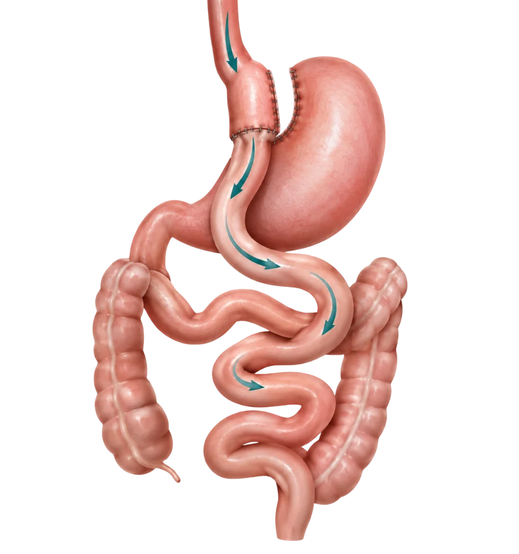 Mini-Bypass One Anastomosis Gastric Bypass